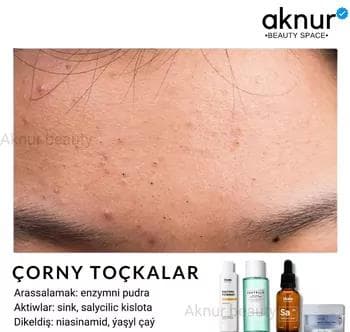 Ýüzdäki gara toçkalarydüýpli arassalap aýyrmak üçin nabor (ORIGINAL)